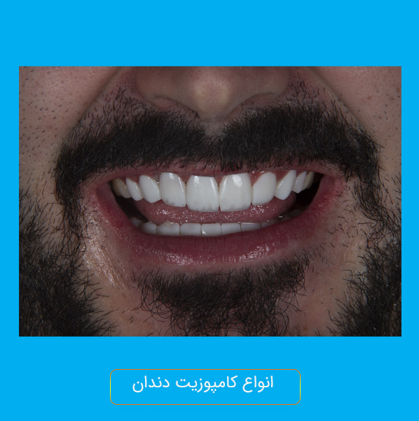 انواع کامپوزیت دندان از نظر ابعاد، کاربرد و محل نصب_ستاره شو 1 انواع کامپوزیت دندان از نظر ابعاد، کاربرد و محل نصب_ستاره شو